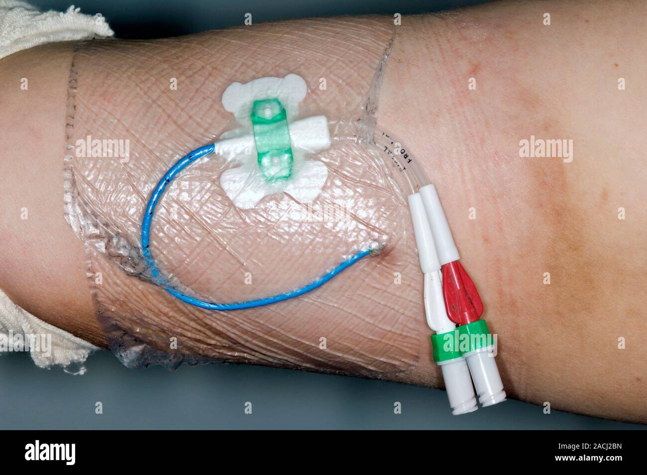 PICC (peripherally inserted central catheter) line inserted into the