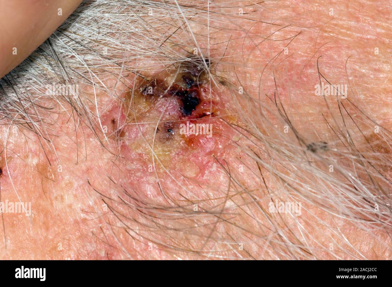 Closeup of basal cell skin cancer (carcinoma) on the temple of the
