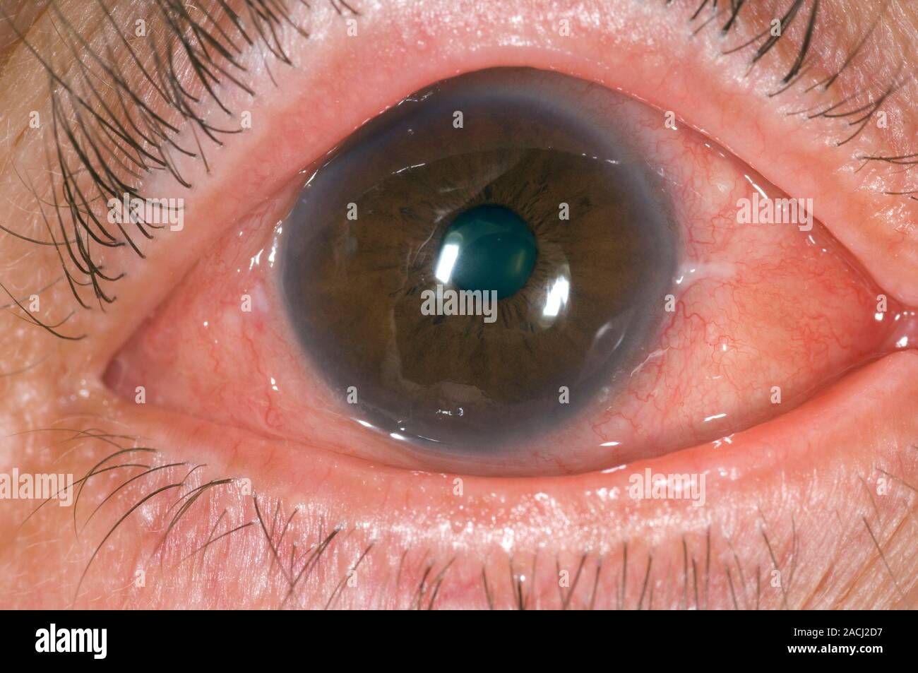 Closeup of the red eye (conjunctivitis) in a 59 year old female