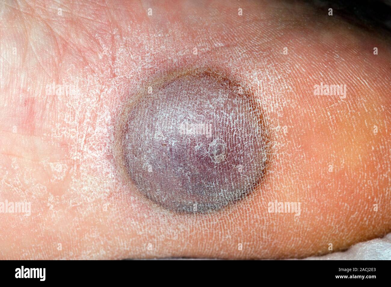Closeup of a wart (verruca) on the sole of the foot in a 50 year old