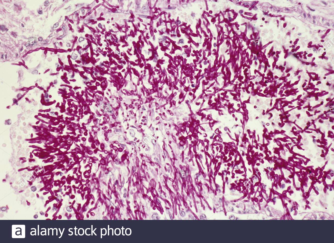 кандидозная пневмония патологическая анатомия. кандида легких. кандида легких. кандида легких. кандида легких.