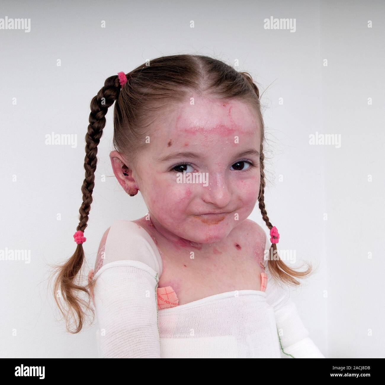 Genetic condition. Five-year old girl with recessive dystrophic Epidermolysis Bullosa (RDEB). This is a very rare genetic disease of the connective ti Stock Photo
