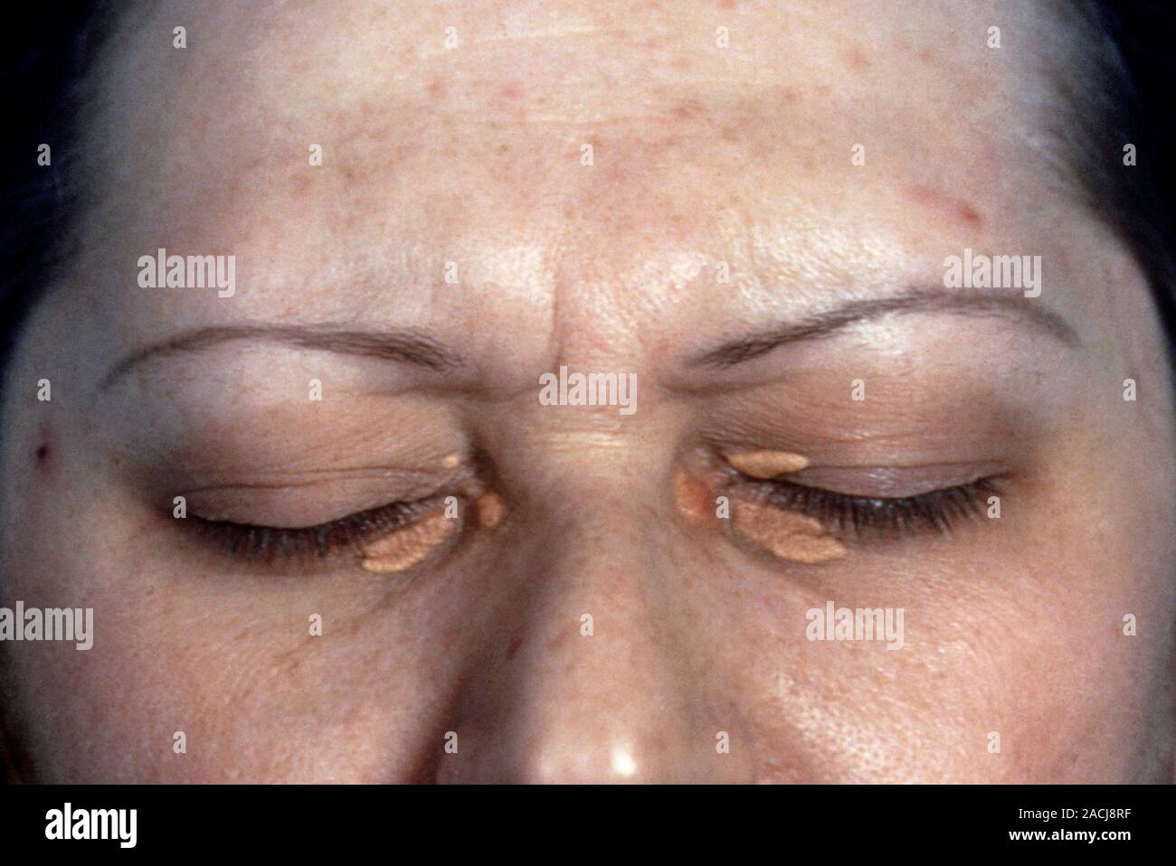 Xanthelasma. Build up of cholesterol (xanthoma) under the skin on the