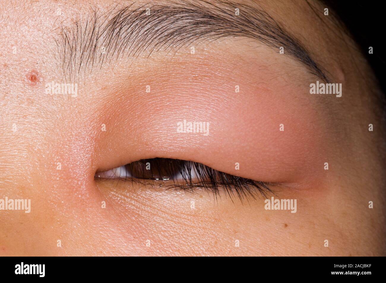 Mosquito bite on eyelid online