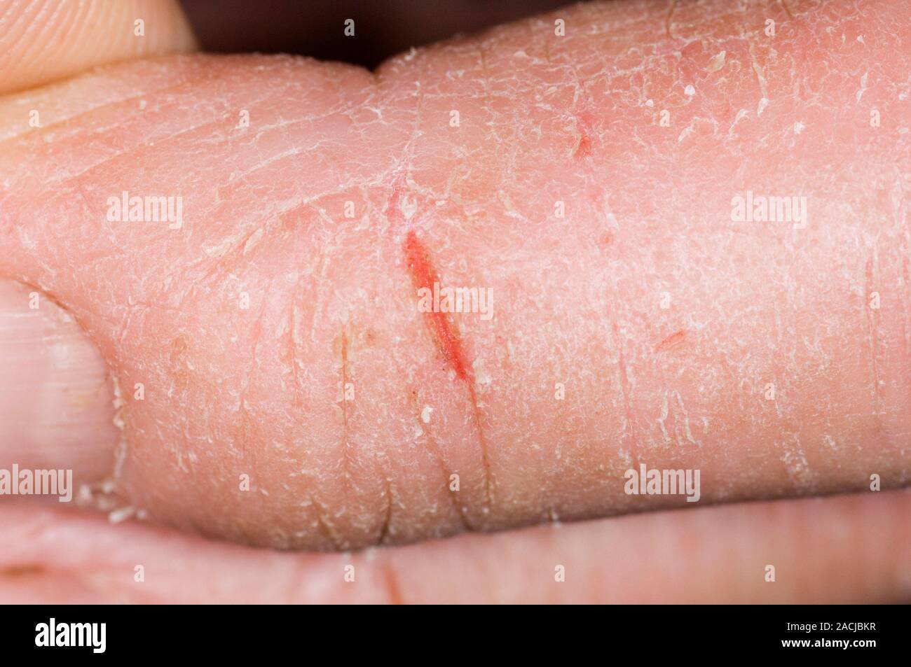 Closeup of cracked skin on the finger in a 70 year old male patient