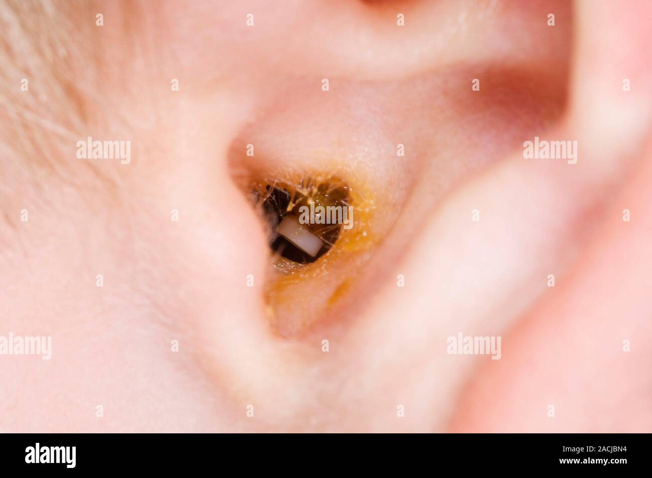 Closeup of the outer ear canal in a 5 year old male patient showing a