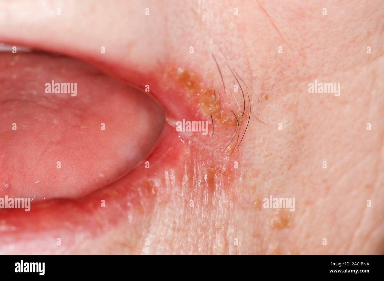 Cracked and splitting of the skin (angular stomatitis) at the sides of ...