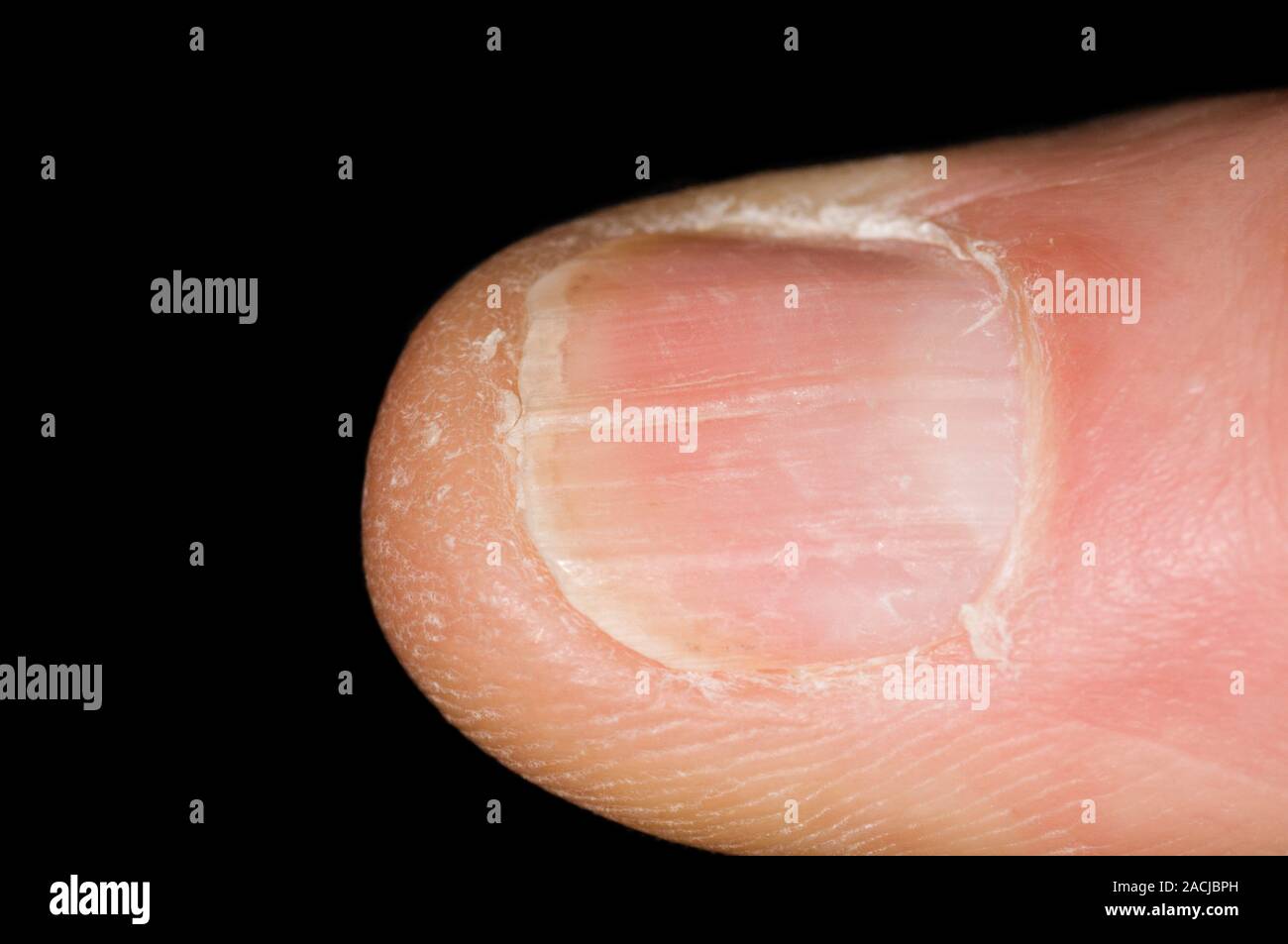 Longitudinal ridges along the fingernail in a 79 year old female