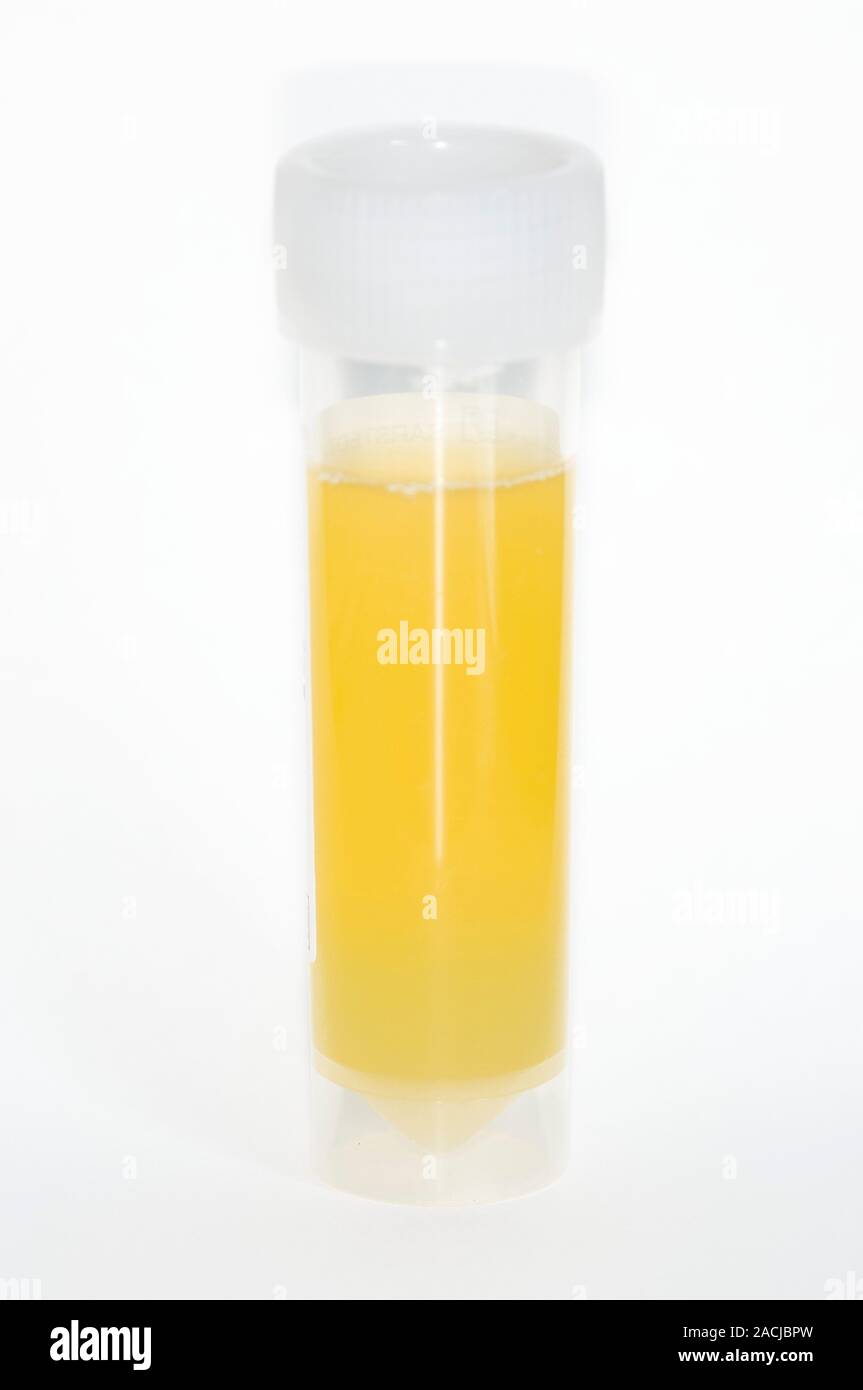 Fluid sample (aspirate) taken from the swollen knee in a 61 year old