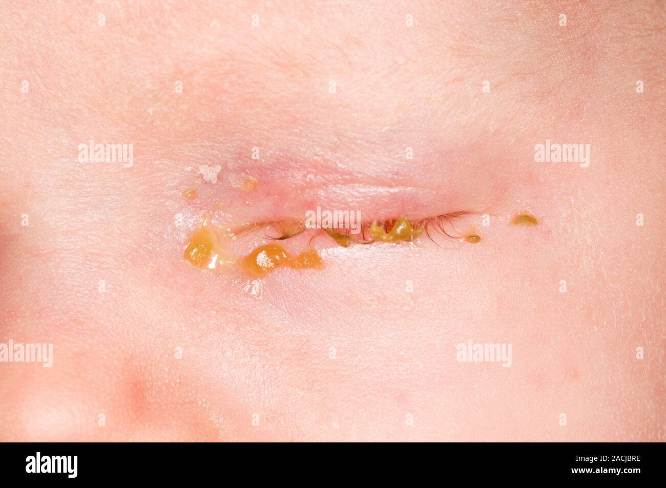 Closeup of pus oozing from the closed eye of a newborn (2 week old