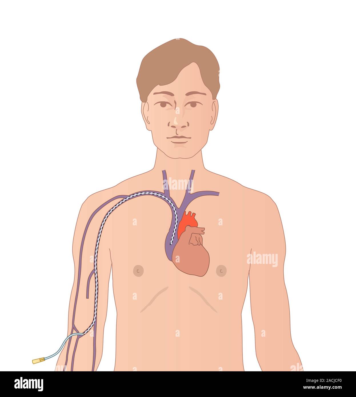 Artwork of a Hickman line showing a catheter inserted though a vein in