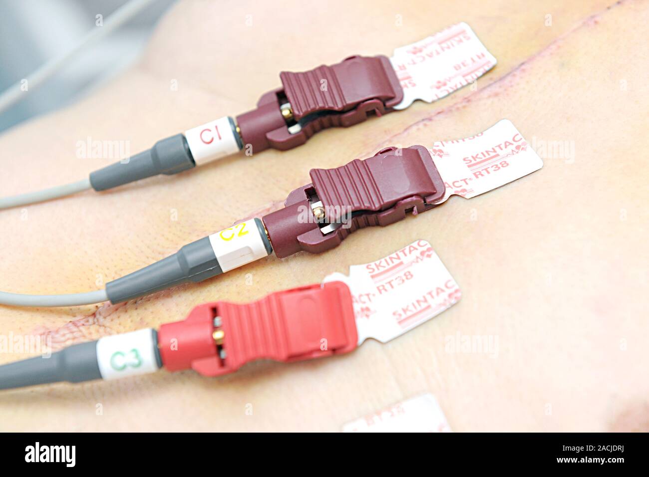 Heart monitoring. Closeup of electrodes on a patient's chest during an