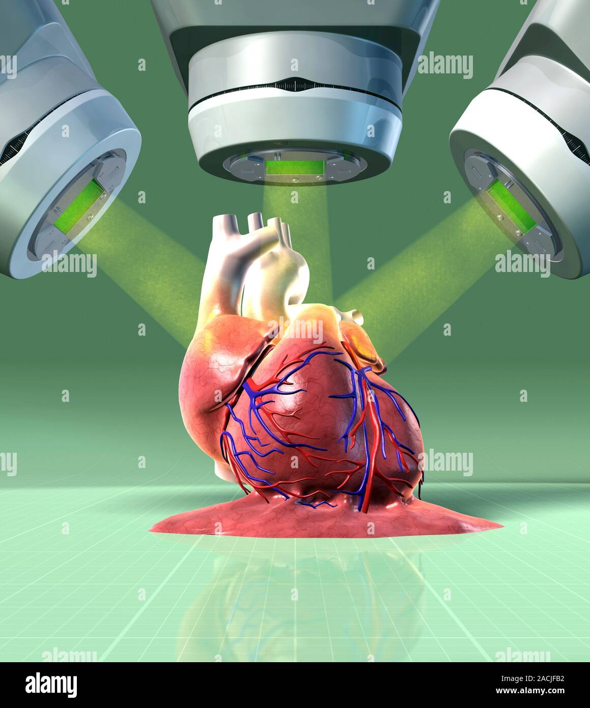 Heart damaged by radiotherapy, conceptual image. Computer artwork