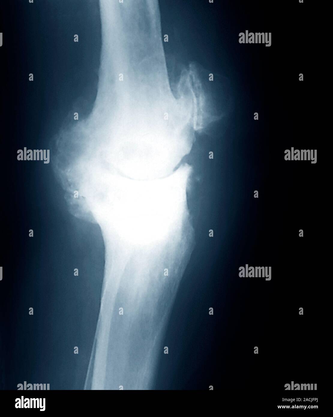 Coloured X-ray (side view) of the leg in a 65 year old patient showing ...