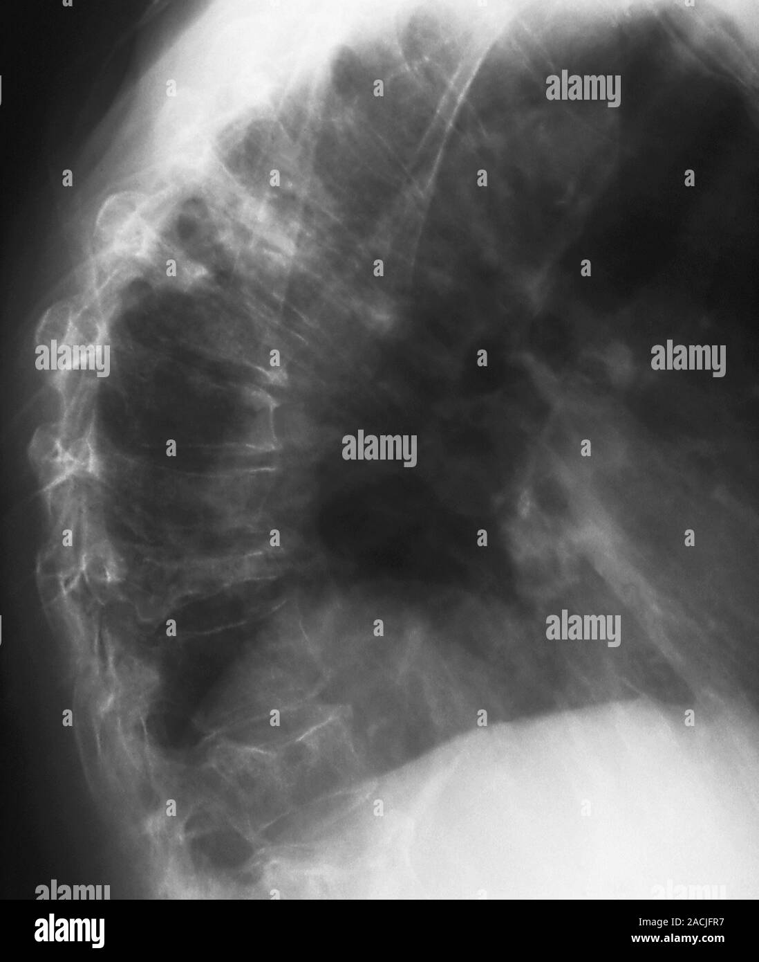 Xray (side view) of the curved spine in a 65 year old patient showing