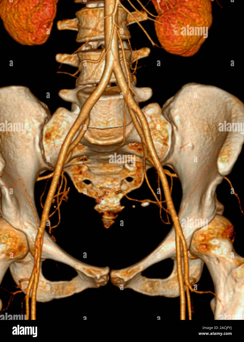 Coloured three-dimensional (3D) computed tomography (CT) angiography ...