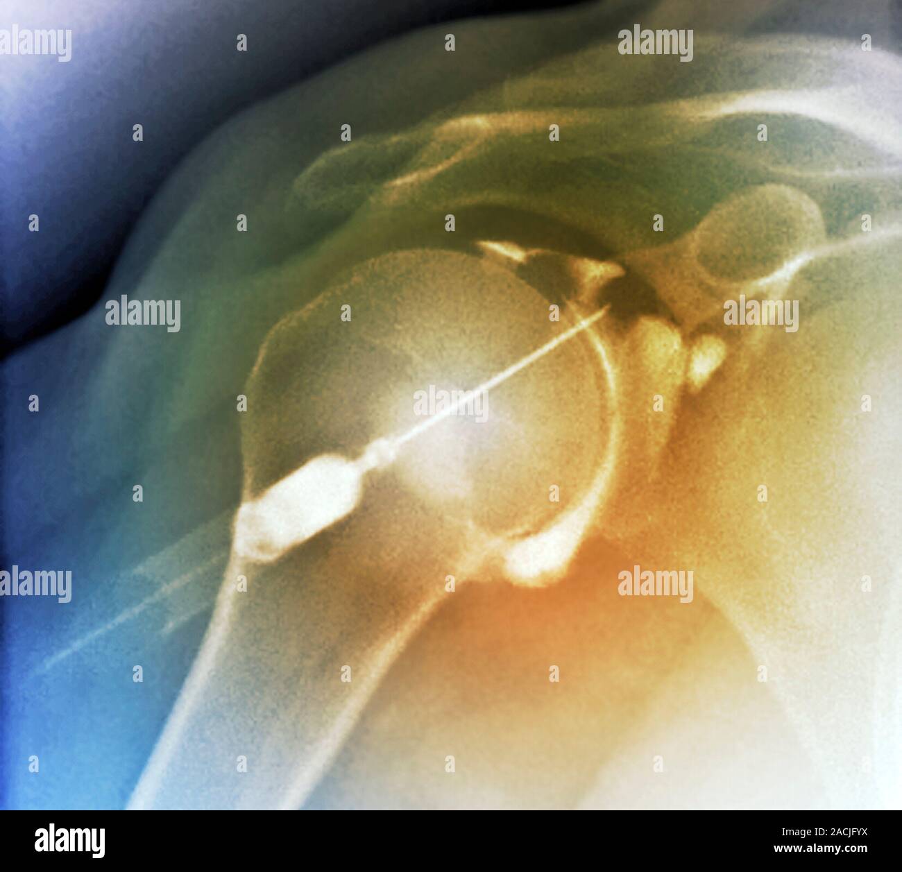 Coloured Xray (side view) of the shoulder in a 64 year old patient