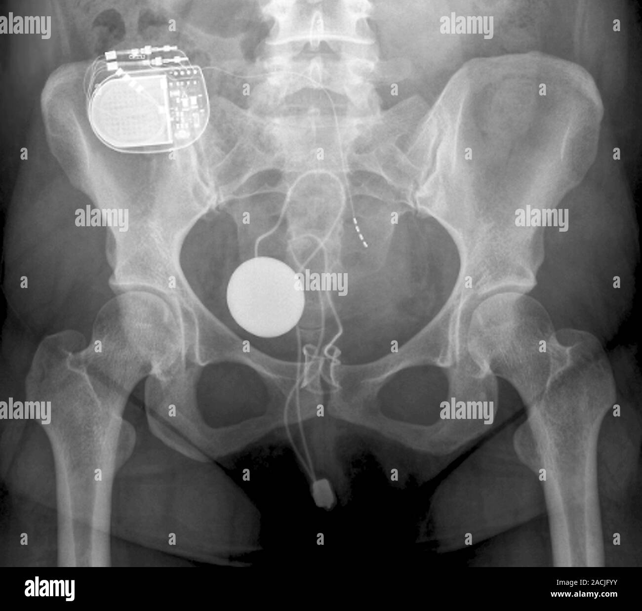 Xray (front view) of the pelvis in a 28 year old disabled female