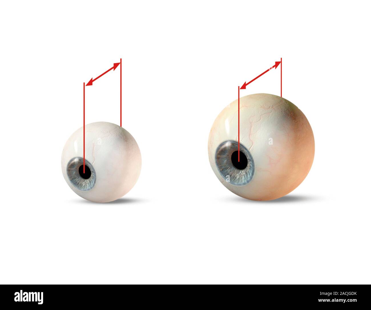 Eye size comparison. Computer artwork showing the difference in diameter between a newborn baby's eye (left) at 18mm, and that of an adult at 24mm. Stock Photo