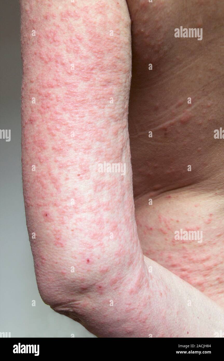 аллергия по телу по сперму фото 21