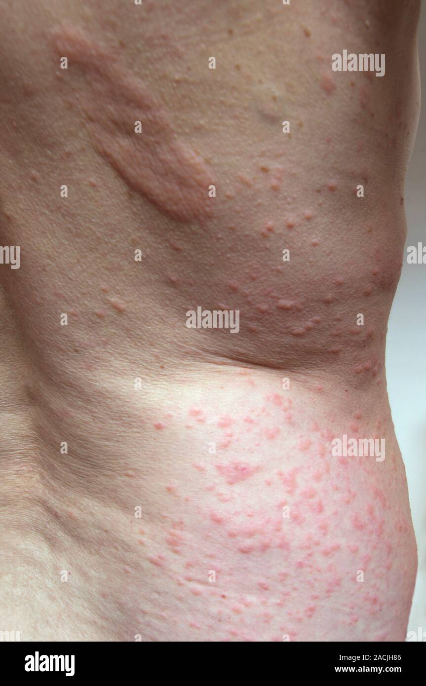 Sun rash on a woman's back. This is an allergic reaction to sunlight. Exposure to sunlight