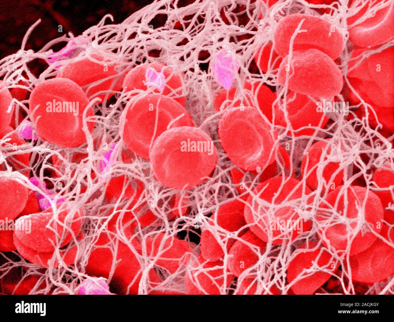 красный тромб белый тромб фибрин. клетки кровеносных сосудов. микроциркуляция презентация. нити фибрина под микроскопом. гемостаз 5000.
