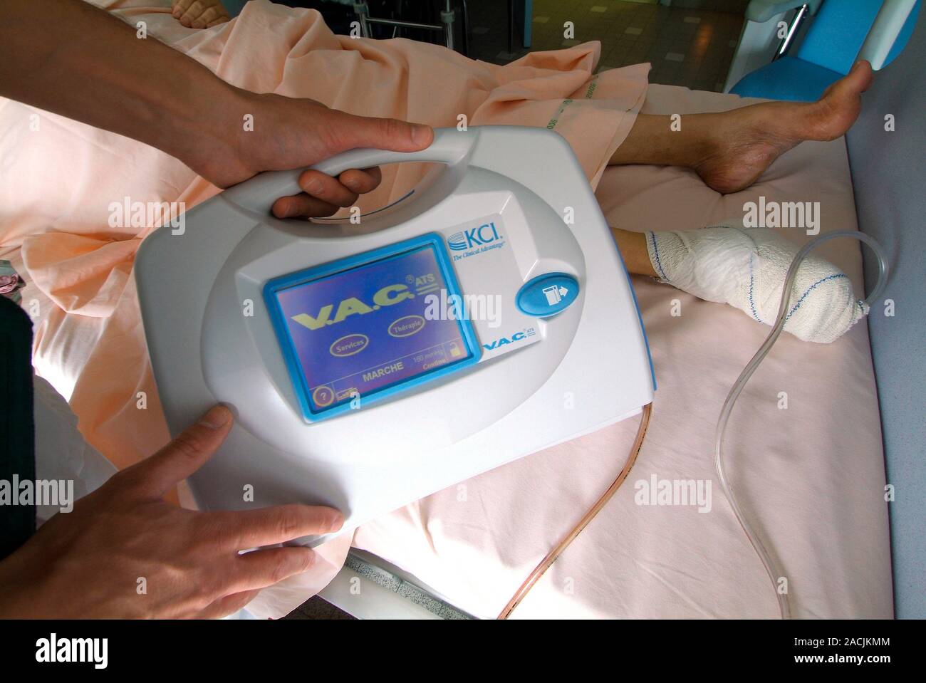 Negative pressure wound therapy (NPWT). Nurse using a vacuum dressing