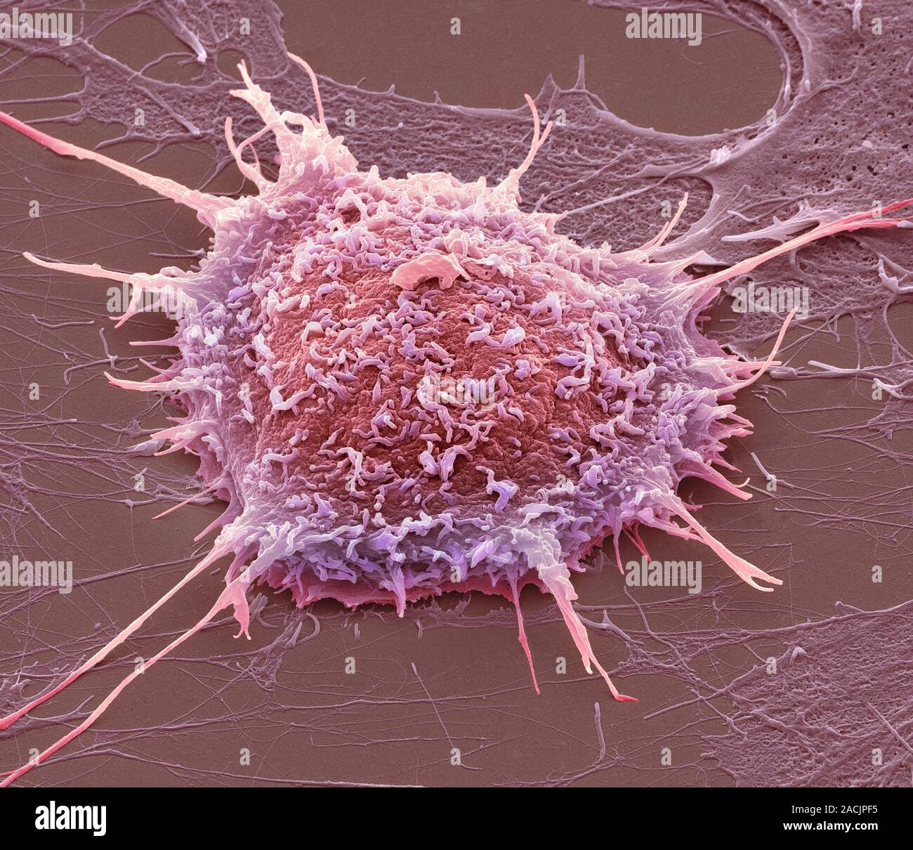 Cervical Cancer Cell, Coloured Scanning Electron Micrograph (sem 