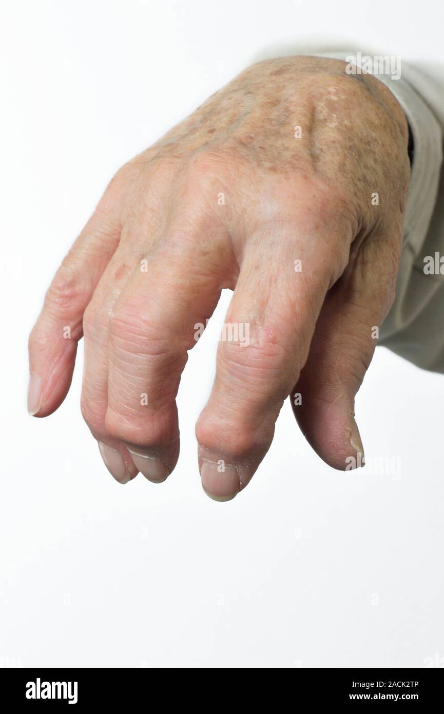 Not for use in Television Not for use in Television Osteoarthritis of