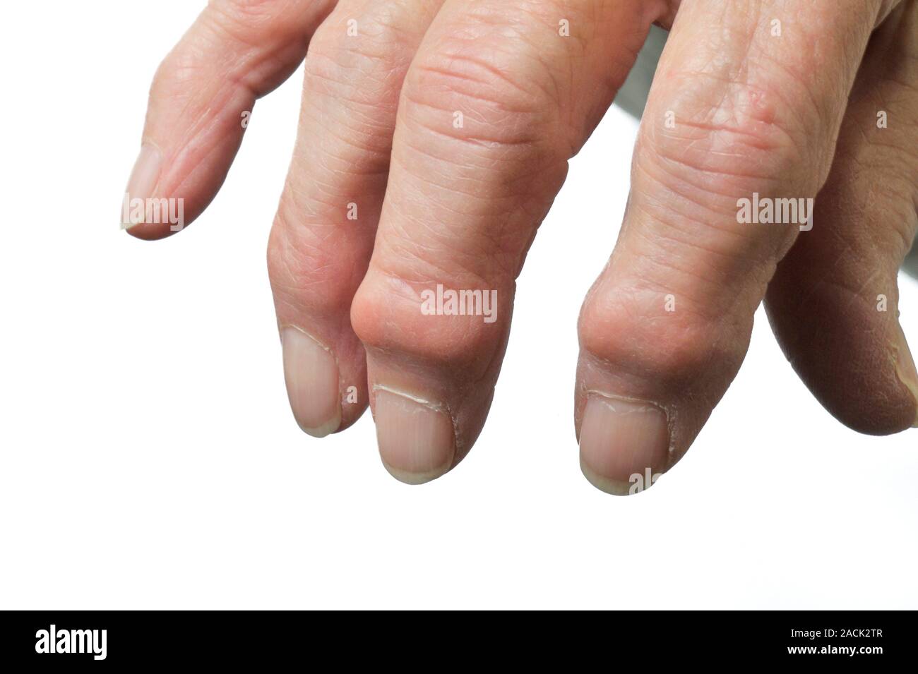 Not for use in Television Not for use in Television Osteoarthritis of