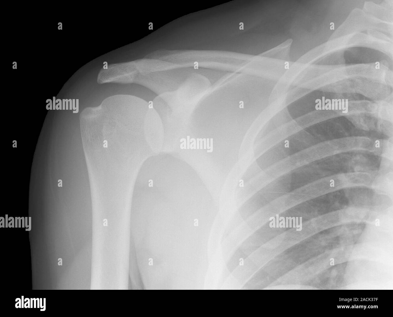 Normal shoulder. Xray of the healthy shoulder of a young adult male