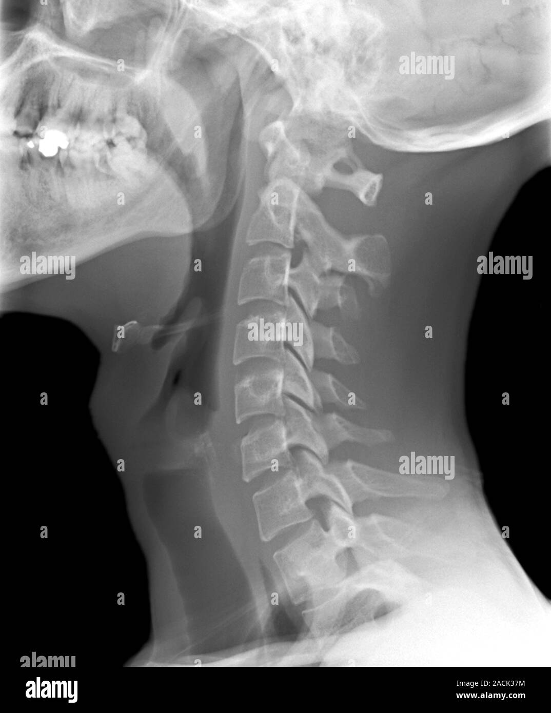 Noraml neck. Xray of the healthy cervical (neck) spine of a 29 year