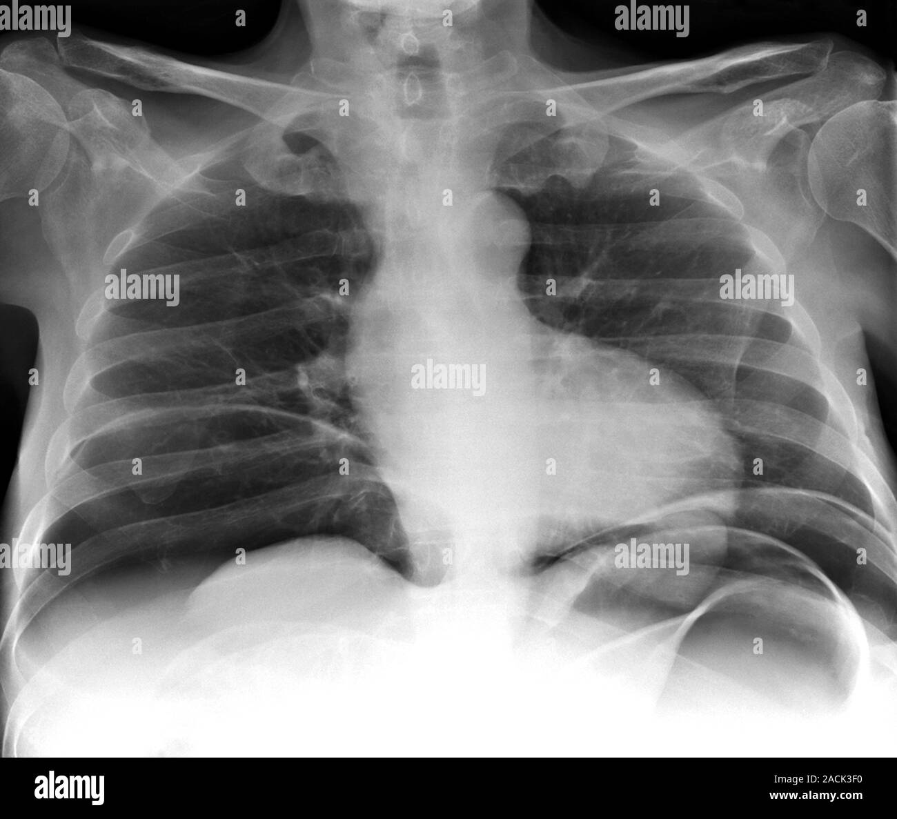 Abdominal air pockets. Chest Xray of a 44 year old patient showing air