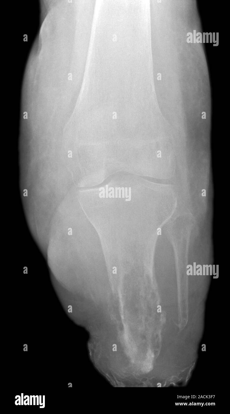 Bone infection. Xray of the knee of a 75 year old female patient with