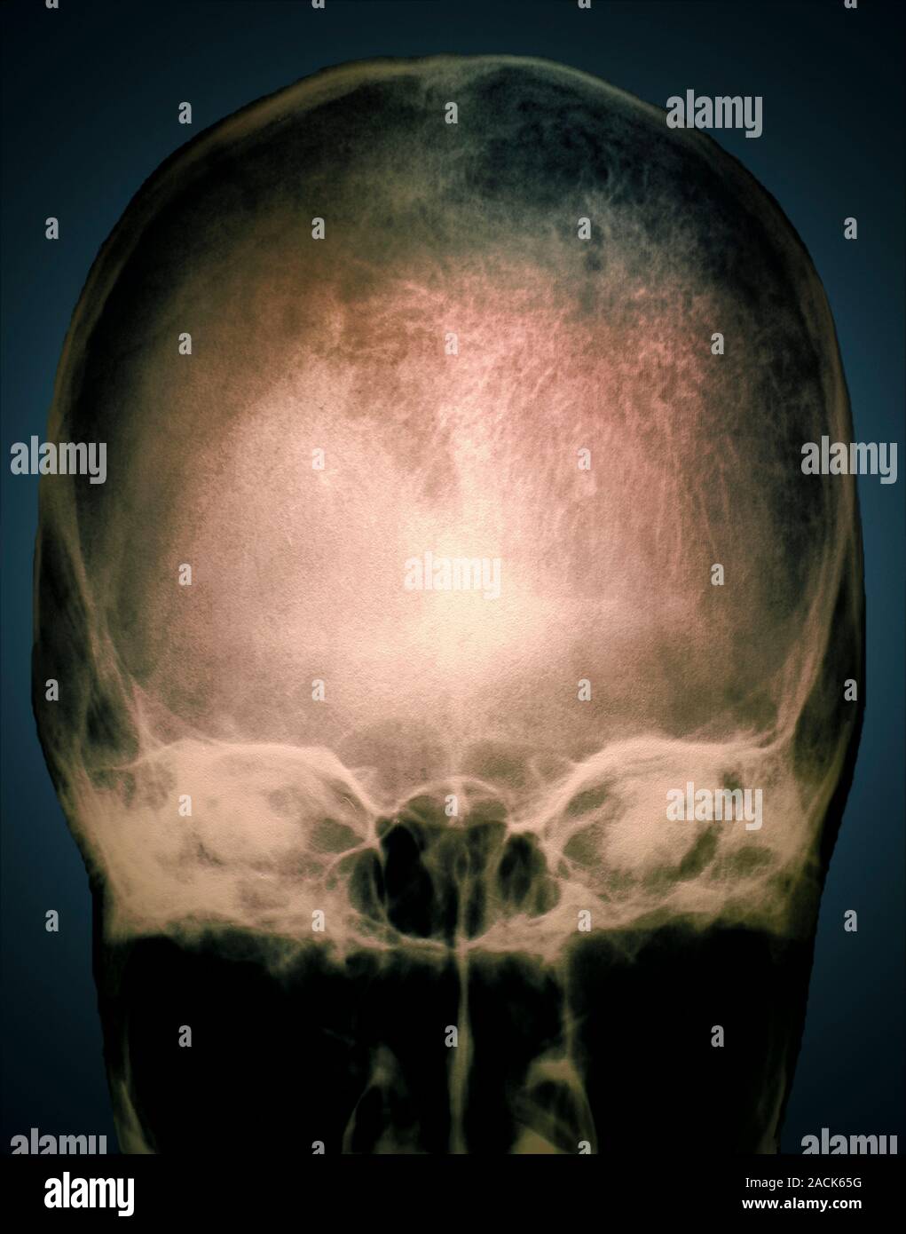 Osteoporosis in the skull. Coloured Xray of the skull of a 71yearold