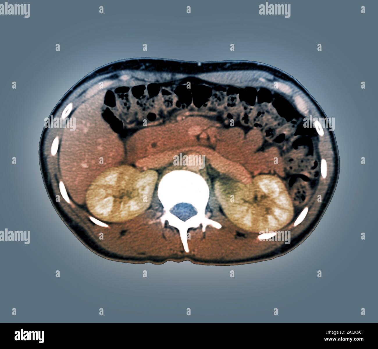 Medullary sponge kidney. Coloured computed tomography (CT) scan in