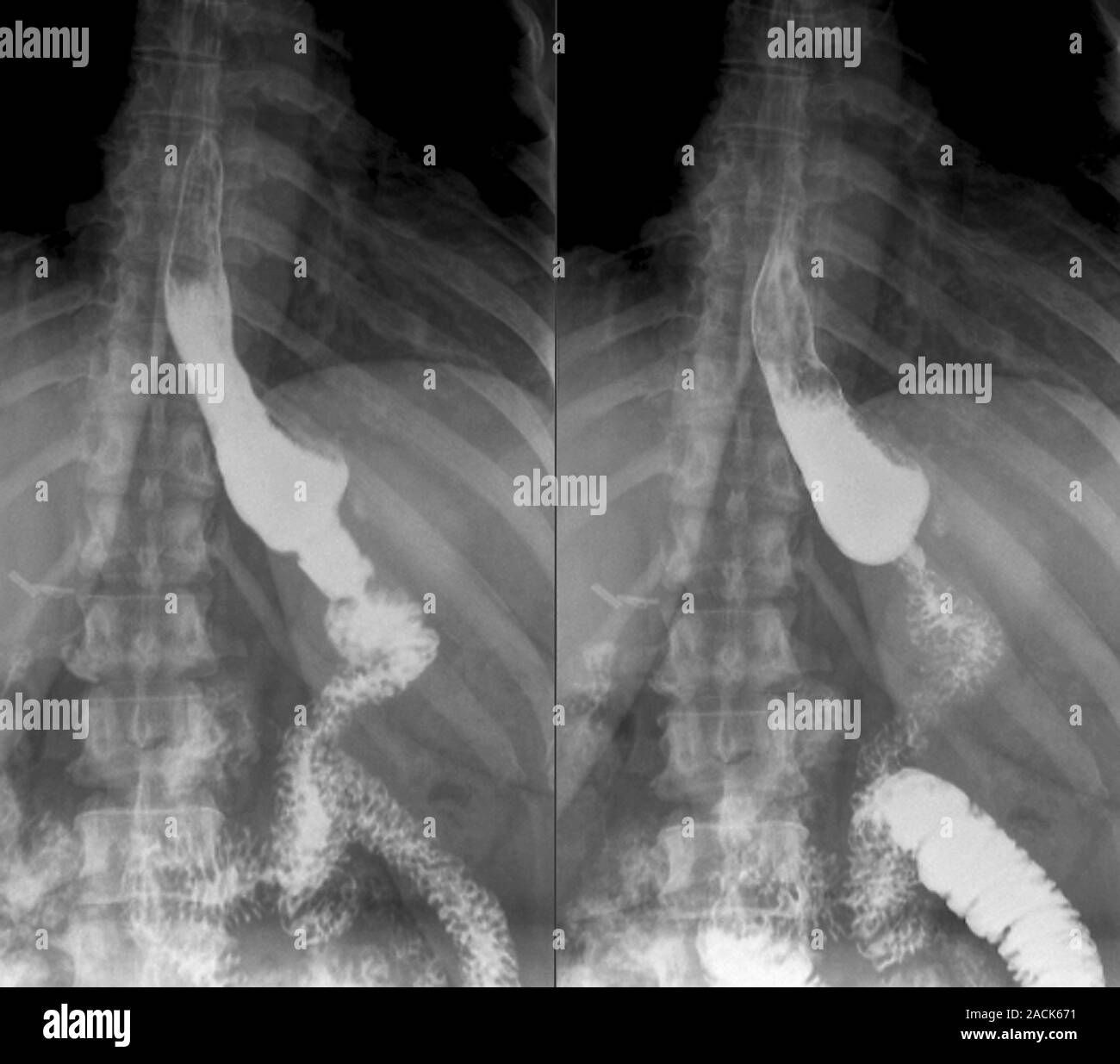 Gastric bypass surgery. Frontal Xrays of a 48yearold obese patient