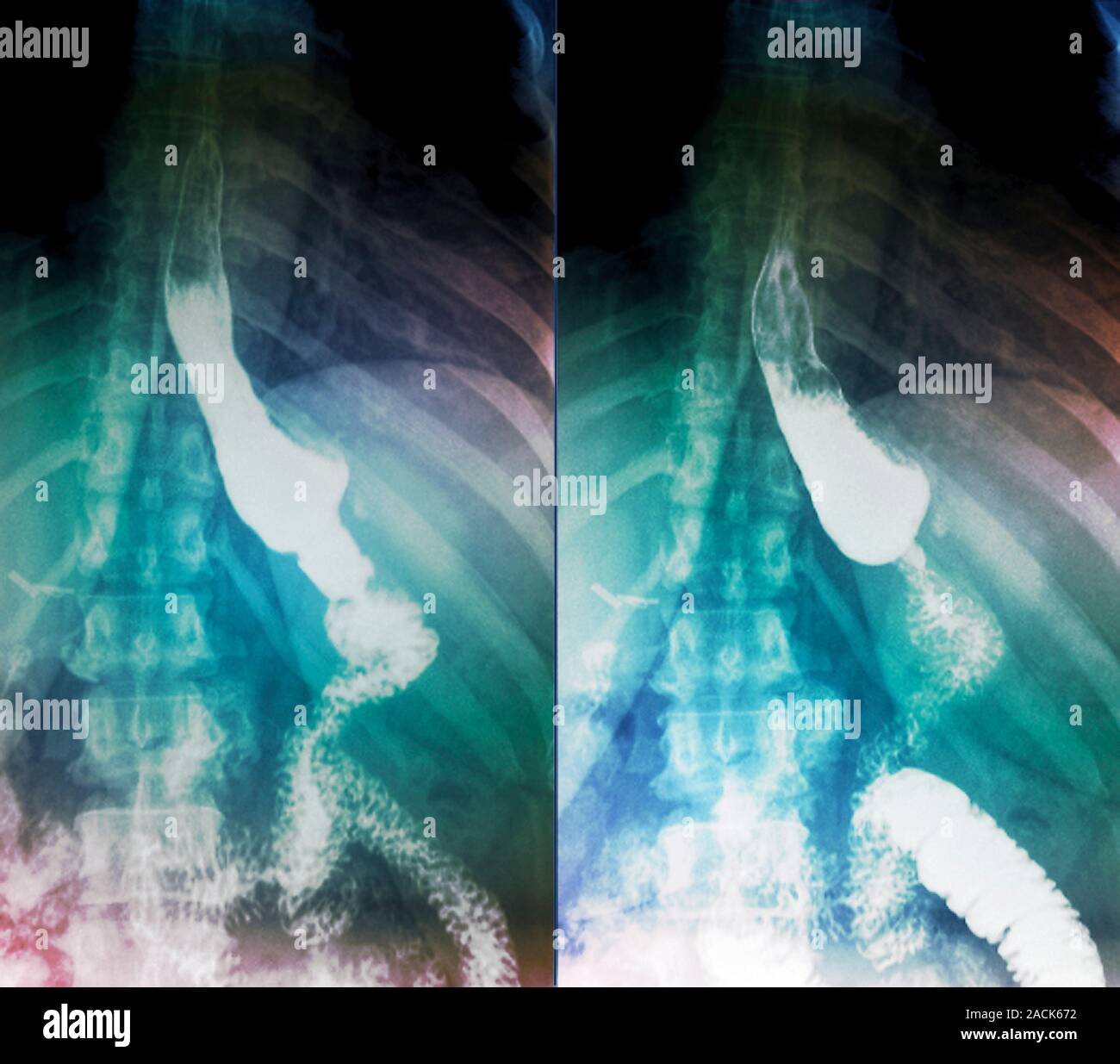 Gastric bypass surgery. Coloured frontal Xrays of a 48yearold obese