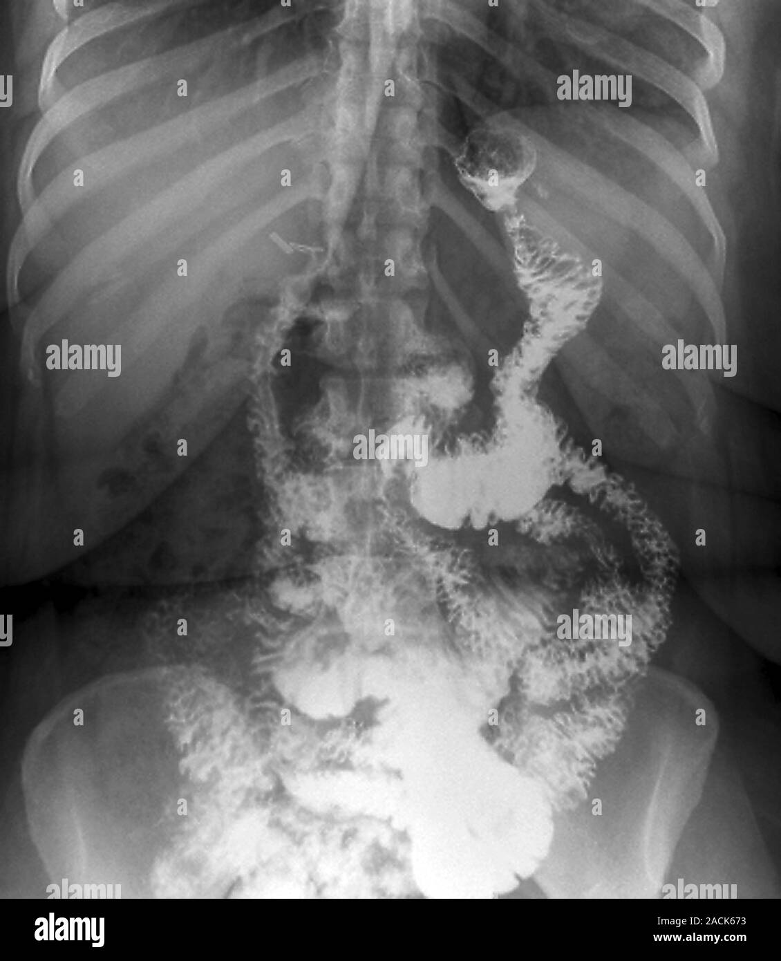 Gastric bypass surgery. Frontal Xrays of a 48yearold obese patient