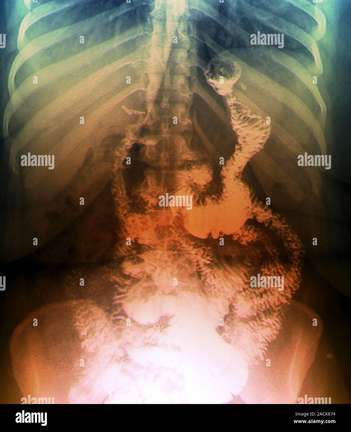 Gastric bypass surgery. Coloured frontal Xrays of a 48yearold obese
