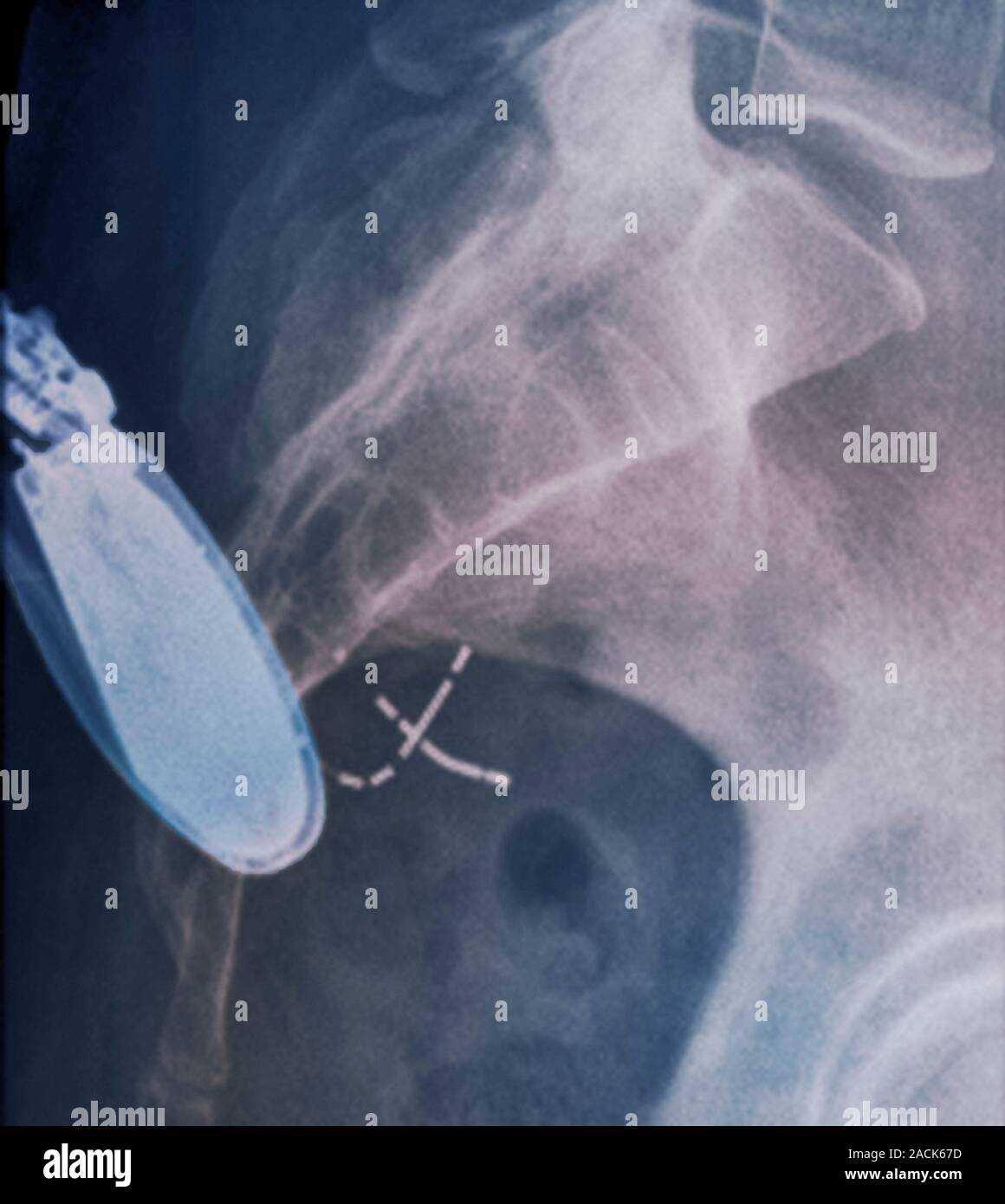 Incontinence implant. Coloured profile Xray of the pelvic region of a