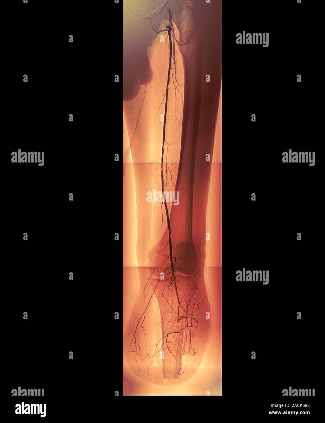 Diabetic amputee. Coloured angiogram X-ray of the left leg of a 54-year ...