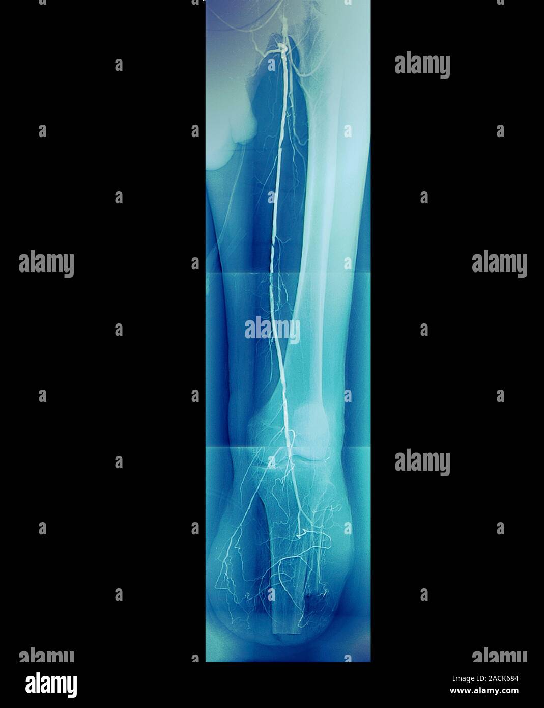 Diabetic amputee. Coloured angiogram X-ray of the left leg of a 54-year ...