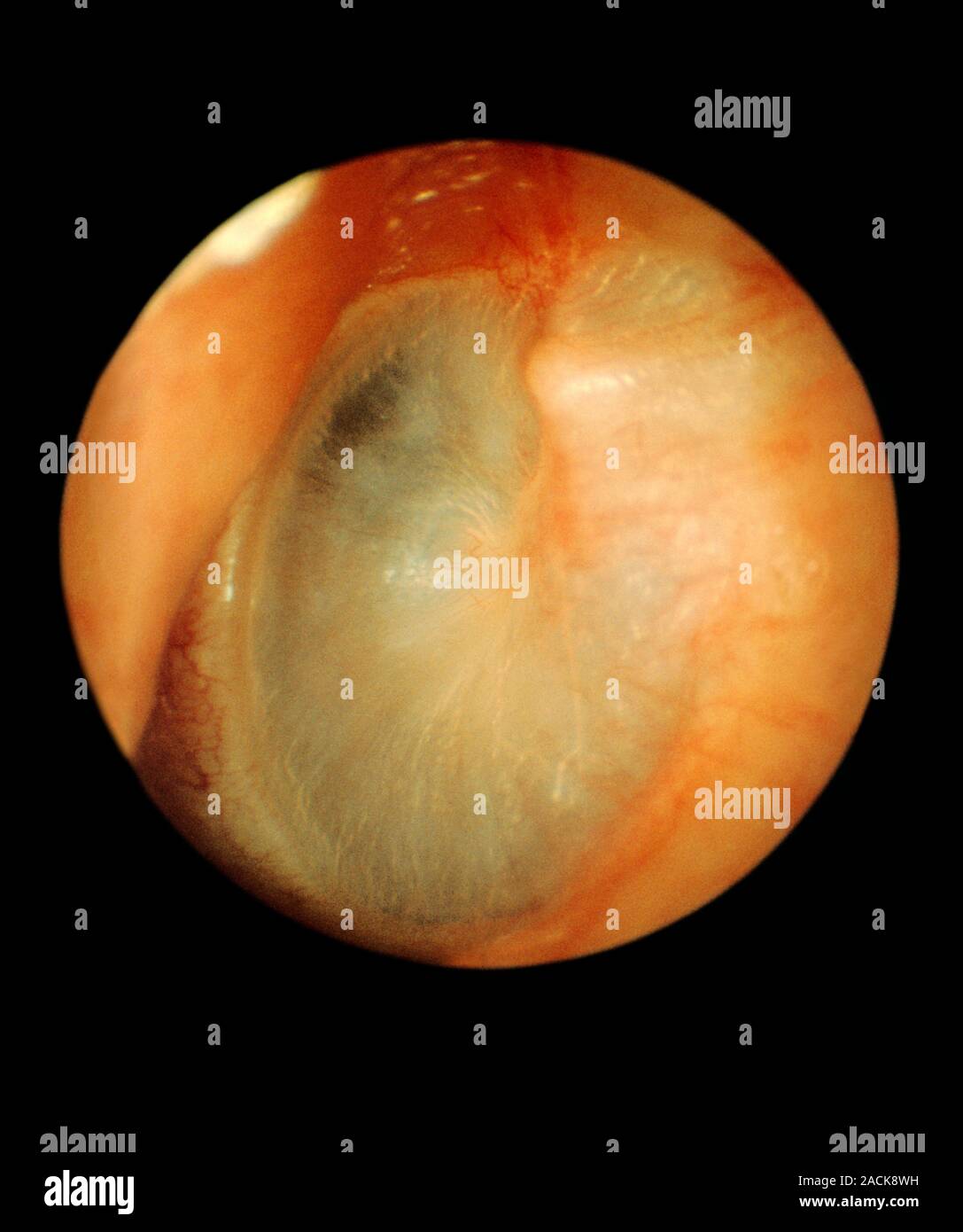 Eardrum, otoscope view. The eardrum (tympanic membrane) separated the