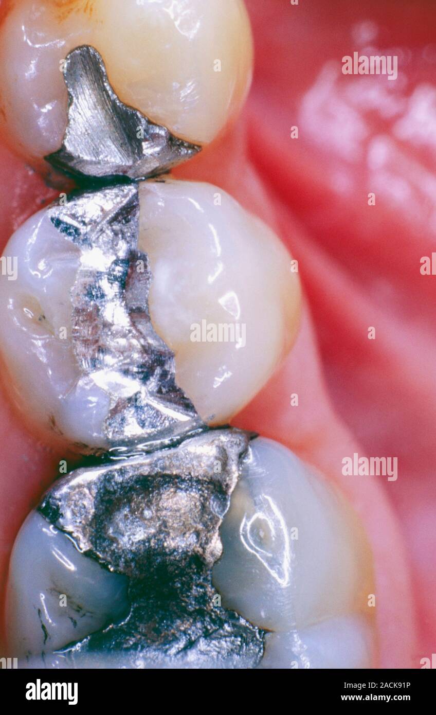 Dental fillings. Closeup of amalgam fillings in a patient's molars and