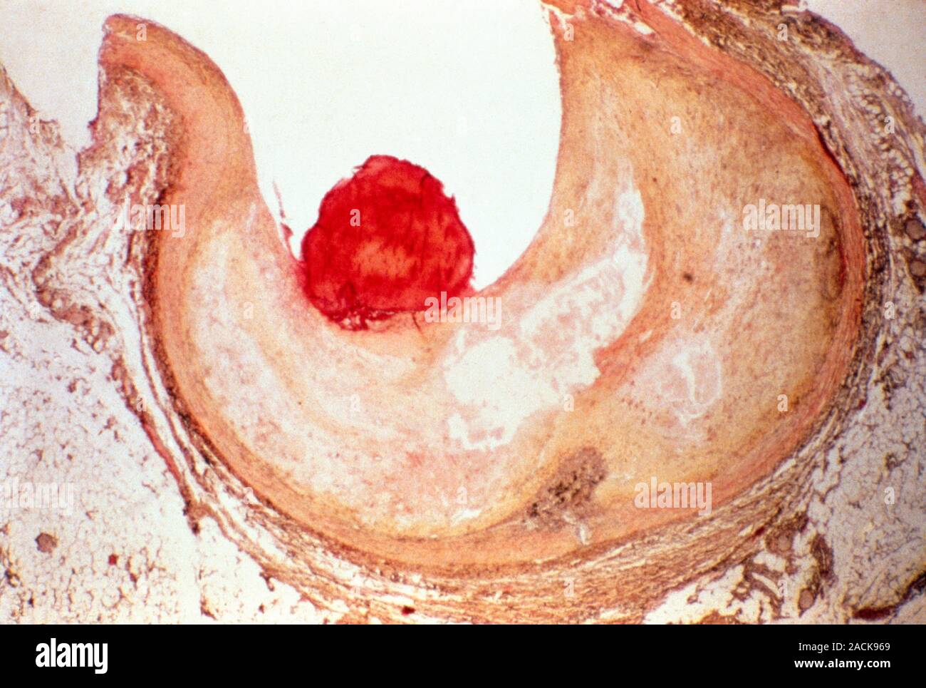 Atherosclerosis and blood clot, light micrograph. Atherosclerotic