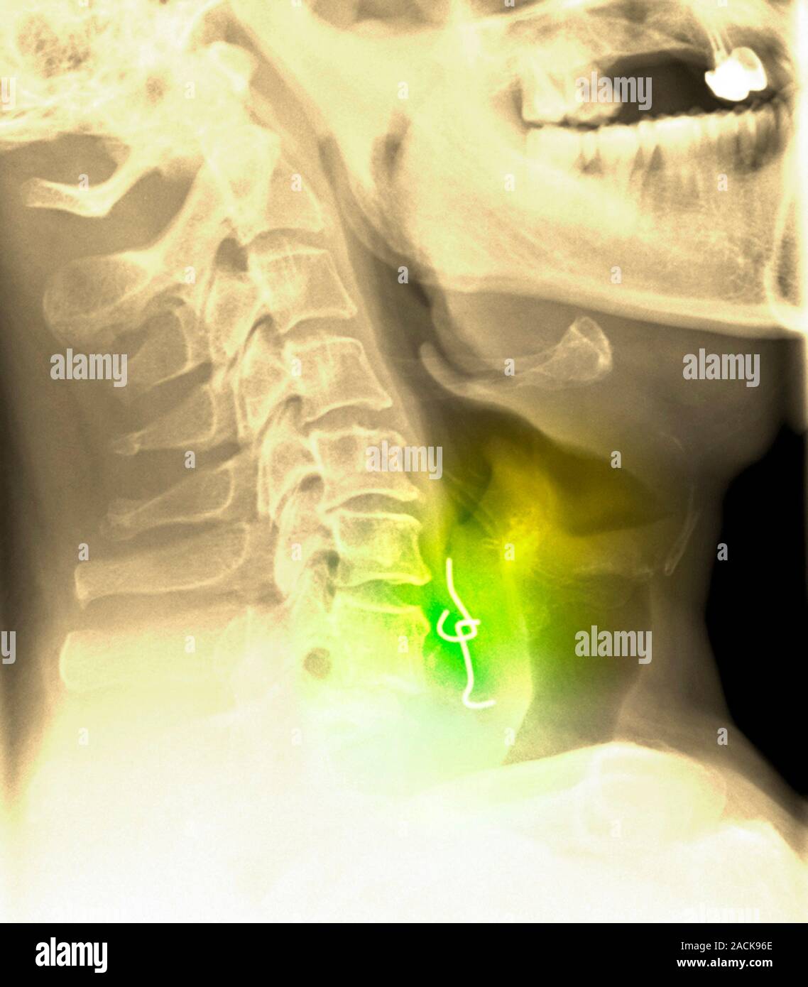 Swallowed denture. Coloured Xray of a 49 year old male patient's neck