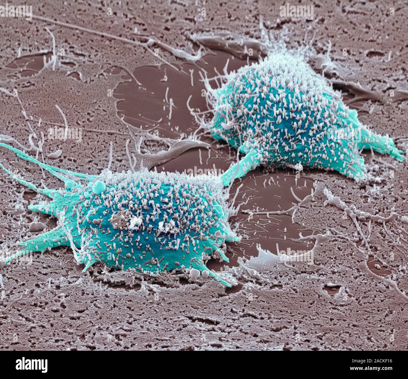 Dividing cancer cell. Coloured scanning electron micrograph (SEM) of a ...