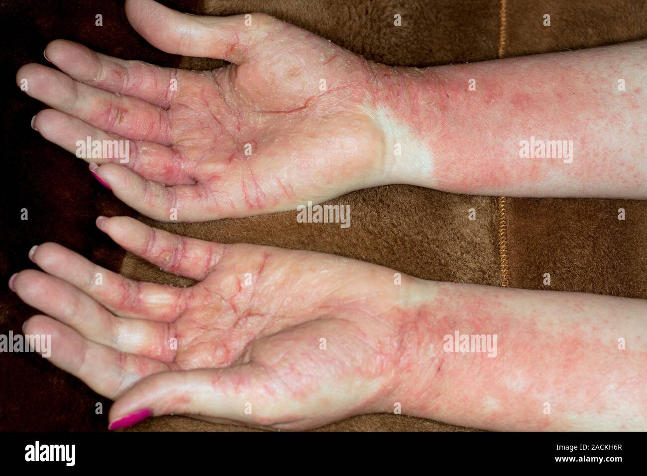 Sudden Rash On Hand Red rash of eczema on the hands of an adult female patient caused by an ...