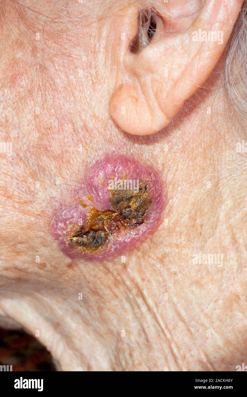 Close Up Of A Basal Cell Carcinoma Skin Cancer On The Cheek Of The